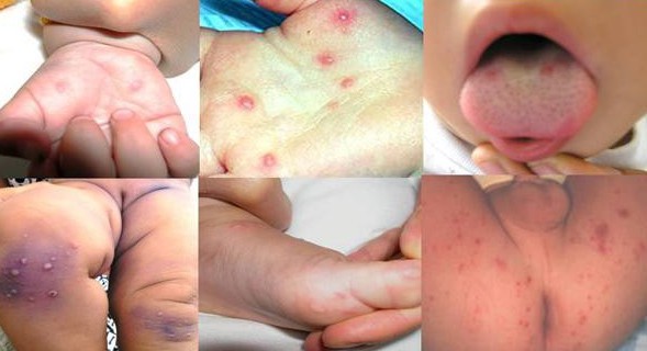 Trong 1 tuần có thêm 14 ca mắc tay chân miệng: Đây là dấu hiệu bệnh tay chân miệng và việc cha mẹ cần làm ngay để phòng bệnh cho con - 1 Trong 1 tuần có thêm 14 ca mắc tay chân miệng: Đây là dấu hiệu bệnh tay chân miệng và việc cha mẹ cần làm ngay để phòng bệnh cho con - 1