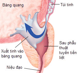 Cách ngừa và trị rối loạn xuất tinh - 1 Cách ngừa và trị rối loạn xuất tinh - 1