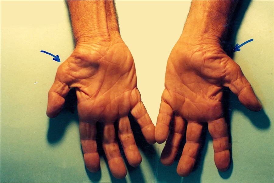 Dấu hiệu đau nhói, tê đầu ngón tay cảnh báo những vấn đề sức khỏe cực nghiêm trọng - 1 Dấu hiệu đau nhói, tê đầu ngón tay cảnh báo những vấn đề sức khỏe cực nghiêm trọng - 1