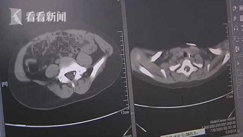 Cháu bé 8 tuổi thường xuyên đau đớn đến phát khóc, đến viện kiểm tra mới biết dị vật bị 'bỏ quên' trong cổ tới 6 năm Cháu bé 8 tuổi thường xuyên đau đớn đến phát khóc, đến viện kiểm tra mới biết dị vật bị 'bỏ quên' trong cổ tới 6 năm