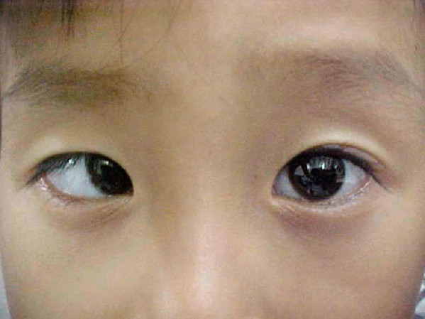 Cậu bé 10 tuổi bất ngờ bị... lác sau khi chơi điện thoại ròng rã 10 tiếng/ngày trong suốt kỳ nghỉ hè - 1 Cậu bé 10 tuổi bất ngờ bị... lác sau khi chơi điện thoại ròng rã 10 tiếng/ngày trong suốt kỳ nghỉ hè - 1