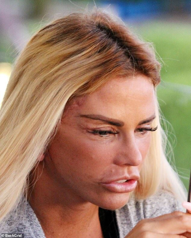 Thảm họa dao kéo hot nhất nước Anh Katie Price: Từng đẹp đến mức Ronaldo mê đắm, bỏ rơi mẹ già ung thư vì nghiện thẩm mỹ - 10 Thảm họa dao kéo hot nhất nước Anh Katie Price: Từng đẹp đến mức Ronaldo mê đắm, bỏ rơi mẹ già ung thư vì nghiện thẩm mỹ - 10