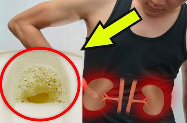 Cẩn thận với những triệu chứng kéo dài đang ngầm cảnh báo nguy cơ suy thận sắp xảy ra - 3 Cẩn thận với những triệu chứng kéo dài đang ngầm cảnh báo nguy cơ suy thận sắp xảy ra - 3
