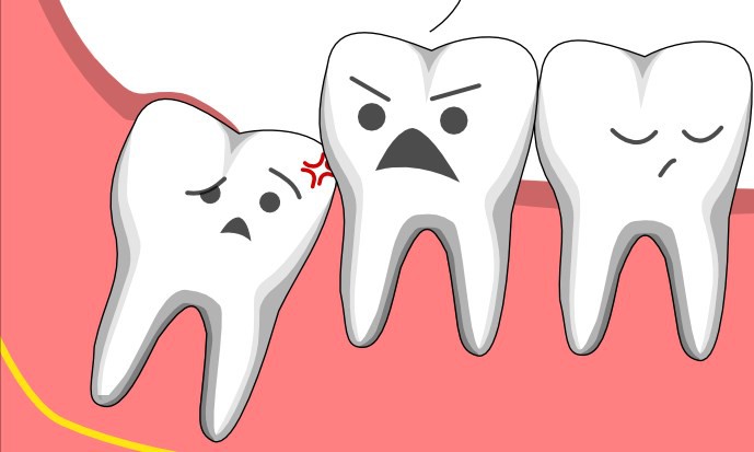 Vì sao mọc ngu lung tung mà lại gọi là răng khôn? - 1 Vì sao mọc ngu lung tung mà lại gọi là răng khôn? - 1