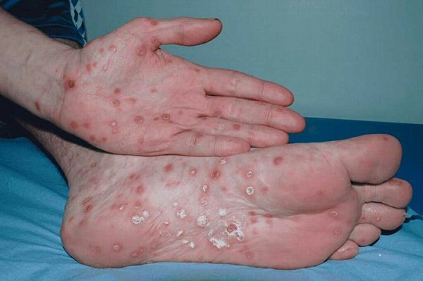 Giám đốc bị tâm thần vì mắc giang mai nhưng không chữa, nguyên nhân không ai ngờ tới - 2 Giám đốc bị tâm thần vì mắc giang mai nhưng không chữa, nguyên nhân không ai ngờ tới - 2
