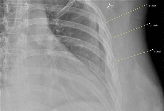Người phụ nữ 30 tuổi này đã uống 10 tách cà phê mỗi ngày và bác sĩ đã sửng sốt khi nhìn kết quả X-quang của cô - 1 Người phụ nữ 30 tuổi này đã uống 10 tách cà phê mỗi ngày và bác sĩ đã sửng sốt khi nhìn kết quả X-quang của cô - 1