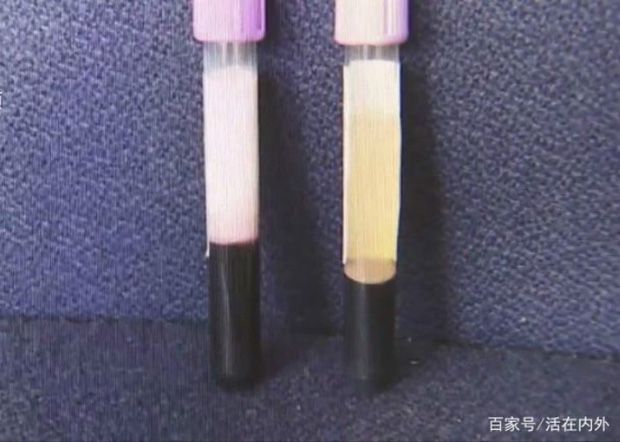 Ăn tới 3 - 4 cái bánh Trung thu một ngày, máu của người đàn ông chuyển từ đỏ sang trắng đục - 1 Ăn tới 3 - 4 cái bánh Trung thu một ngày, máu của người đàn ông chuyển từ đỏ sang trắng đục - 1