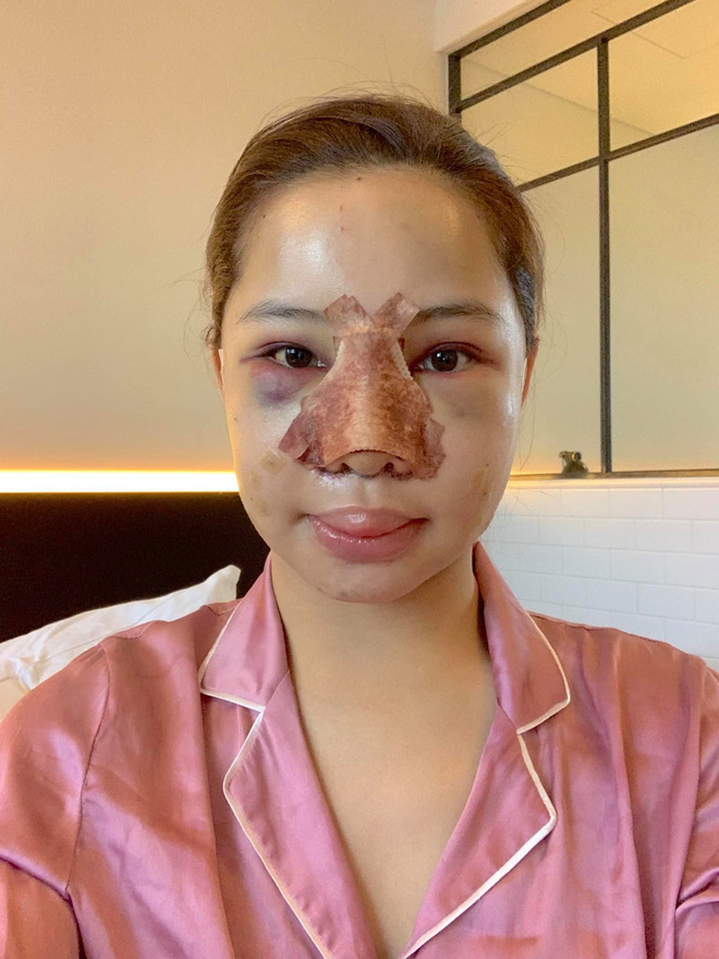 Lưu Đê Ly khoe trải qua 6 ca phẫu thuật ở Hàn để 'đập mặt làm lại', đẹp hay không chưa bàn chỉ biết là quá dũng cảm rồi! - 4 Lưu Đê Ly khoe trải qua 6 ca phẫu thuật ở Hàn để 'đập mặt làm lại', đẹp hay không chưa bàn chỉ biết là quá dũng cảm rồi! - 4