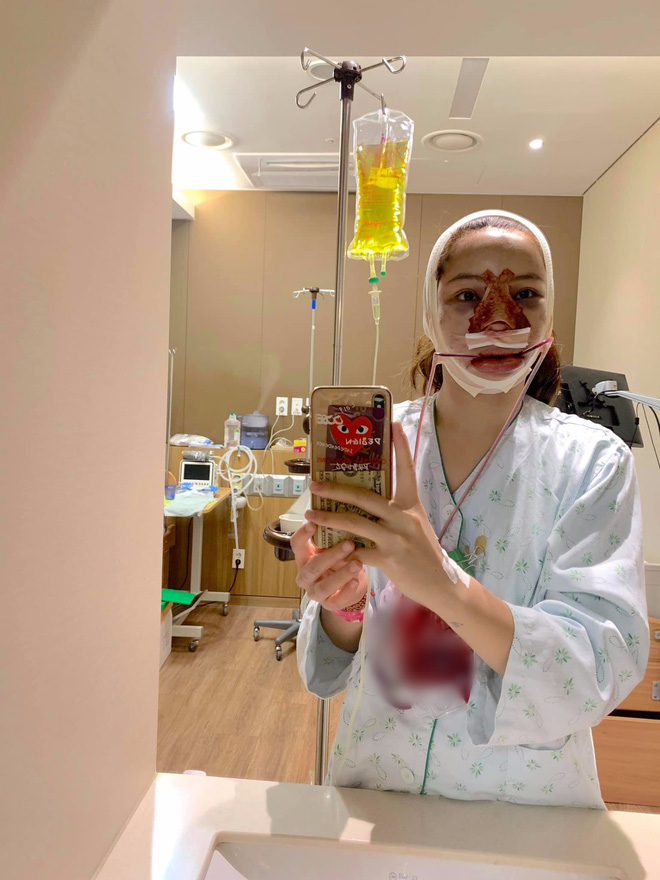 Lưu Đê Ly khoe trải qua 6 ca phẫu thuật ở Hàn để 'đập mặt làm lại', đẹp hay không chưa bàn chỉ biết là quá dũng cảm rồi! - 2 Lưu Đê Ly khoe trải qua 6 ca phẫu thuật ở Hàn để 'đập mặt làm lại', đẹp hay không chưa bàn chỉ biết là quá dũng cảm rồi! - 2