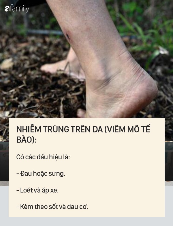 Dấu hiệu bệnh whitmore - căn bệnh do vi khuẩn ăn mòn cơ thể con người, có thể gây tử vong trong vài ngày - 3 Dấu hiệu bệnh whitmore - căn bệnh do vi khuẩn ăn mòn cơ thể con người, có thể gây tử vong trong vài ngày - 3