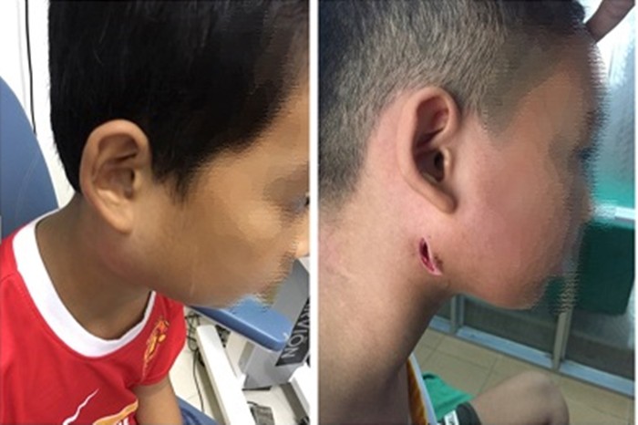 Một bệnh viện ở Nghệ An công bố 3 trẻ nhiễm bệnh Whitmore 'ăn thịt người': Cảnh báo dấu hiệu dễ nhầm lẫn với bệnh quai bị Một bệnh viện ở Nghệ An công bố 3 trẻ nhiễm bệnh Whitmore 'ăn thịt người': Cảnh báo dấu hiệu dễ nhầm lẫn với bệnh quai bị