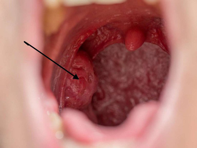 'Ngất xỉu' khi nghe BS báo tin bị mắc 2 bệnh ung thư cùng lúc: Ân hận vì 3 thói quen xấu 'Ngất xỉu' khi nghe BS báo tin bị mắc 2 bệnh ung thư cùng lúc: Ân hận vì 3 thói quen xấu