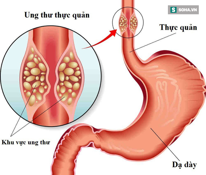 'Ngất xỉu' khi nghe BS báo tin bị mắc 2 bệnh ung thư cùng lúc: Ân hận vì 3 thói quen xấu - 1 'Ngất xỉu' khi nghe BS báo tin bị mắc 2 bệnh ung thư cùng lúc: Ân hận vì 3 thói quen xấu - 1
