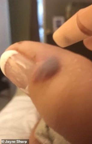 Đi làm móng ở spa, người phụ nữ bị nhiễm vi khuẩn 'ăn thịt người' và phải cắt bỏ 1 phần ngón tay cái - 4 Đi làm móng ở spa, người phụ nữ bị nhiễm vi khuẩn 'ăn thịt người' và phải cắt bỏ 1 phần ngón tay cái - 4