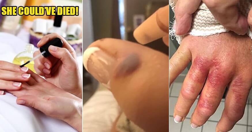 Đi làm móng ở spa, người phụ nữ bị nhiễm vi khuẩn 'ăn thịt người' và phải cắt bỏ 1 phần ngón tay cái Đi làm móng ở spa, người phụ nữ bị nhiễm vi khuẩn 'ăn thịt người' và phải cắt bỏ 1 phần ngón tay cái