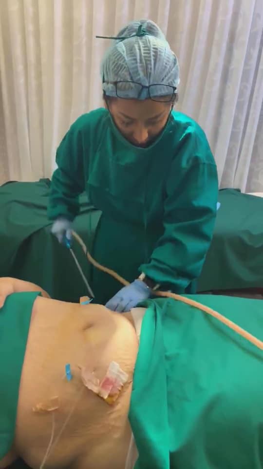 Cận cảnh dùng ống hút mỡ xiên bụng khách bị bóc phốt 'như chọc tiết lợn' Cận cảnh dùng ống hút mỡ xiên bụng khách bị bóc phốt 'như chọc tiết lợn'
