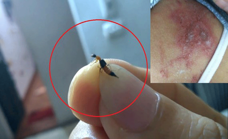 Phân biệt vết thương do kiến ba khoang với viêm da do zona để tránh dùng sai thuốc khiến bệnh càng khó chữa - 1 Phân biệt vết thương do kiến ba khoang với viêm da do zona để tránh dùng sai thuốc khiến bệnh càng khó chữa - 1