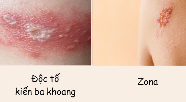 Phân biệt vết thương do kiến ba khoang với viêm da do zona để tránh dùng sai thuốc khiến bệnh càng khó chữa Phân biệt vết thương do kiến ba khoang với viêm da do zona để tránh dùng sai thuốc khiến bệnh càng khó chữa