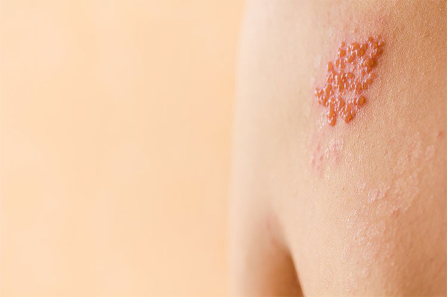 Phân biệt vết thương do kiến ba khoang với viêm da do zona để tránh dùng sai thuốc khiến bệnh càng khó chữa - 2 Phân biệt vết thương do kiến ba khoang với viêm da do zona để tránh dùng sai thuốc khiến bệnh càng khó chữa - 2