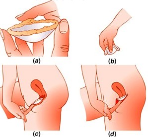 Chọn cách tránh thai theo độ tuổi và tình trạng quan hệ tình dục - 2 Chọn cách tránh thai theo độ tuổi và tình trạng quan hệ tình dục - 2