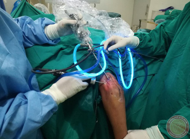Đắp lá trị vết thương, chàng trai không ngờ có hàng trăm viên sỏi nhỏ màu trắng trong khớp khuỷu tay Đắp lá trị vết thương, chàng trai không ngờ có hàng trăm viên sỏi nhỏ màu trắng trong khớp khuỷu tay