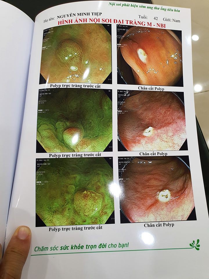 Bệnh polyp đại tràng và polyp dạ dày mà diễn viên Minh Tiệp vừa phát hiện có thể tiến triển thành ung thư không? - 2 Bệnh polyp đại tràng và polyp dạ dày mà diễn viên Minh Tiệp vừa phát hiện có thể tiến triển thành ung thư không? - 2