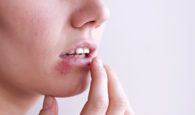 Những nhầm tưởng về mụn rộp sinh dục herpes mà không ít phụ nữ mắc phải Những nhầm tưởng về mụn rộp sinh dục herpes mà không ít phụ nữ mắc phải