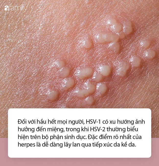 Những nhầm tưởng về mụn rộp sinh dục herpes mà không ít phụ nữ mắc phải - 1 Những nhầm tưởng về mụn rộp sinh dục herpes mà không ít phụ nữ mắc phải - 1