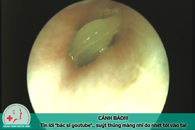 Tin lời 'bác sĩ youtube' nam thanh niên suýt thủng màng nhĩ vì nhét tỏi vào tai chữa bệnh Tin lời 'bác sĩ youtube' nam thanh niên suýt thủng màng nhĩ vì nhét tỏi vào tai chữa bệnh