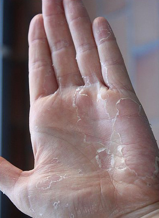 10 biểu hiện bất thường trên tay đang ngầm 'tố cáo' hàng loạt vấn đề sức khỏe mà bạn không ngờ đến 10 biểu hiện bất thường trên tay đang ngầm 'tố cáo' hàng loạt vấn đề sức khỏe mà bạn không ngờ đến