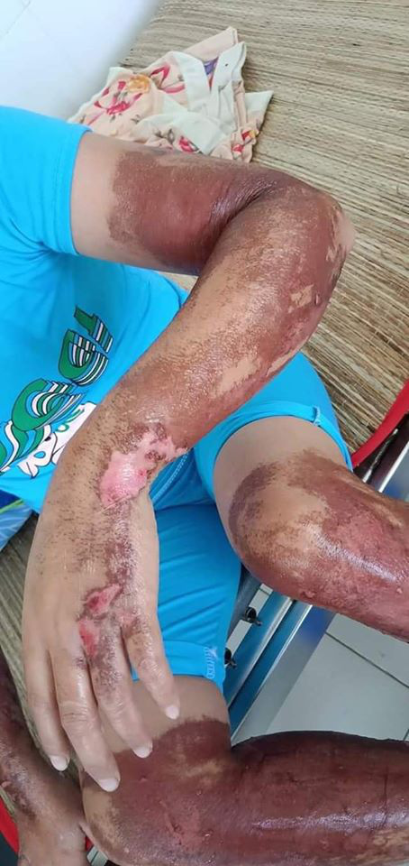 Mua dung dịch lột da trên mạng để có làn da trắng sáng, cô gái lĩnh hậu quả kinh hãi khi da toàn thân như bỏng axit: Trước khi tiến hành lột da cần nhớ điều gì? - 1 Mua dung dịch lột da trên mạng để có làn da trắng sáng, cô gái lĩnh hậu quả kinh hãi khi da toàn thân như bỏng axit: Trước khi tiến hành lột da cần nhớ điều gì? - 1