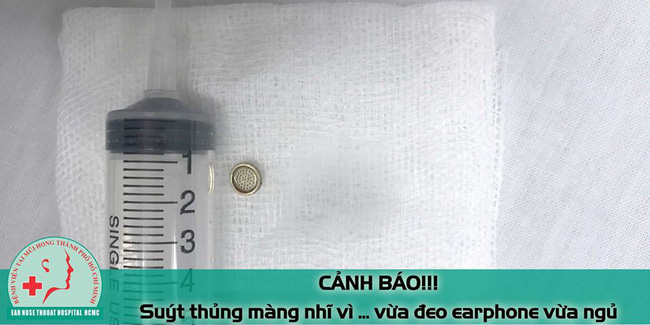 Hy hữu: Bệnh nhân nam suýt thủng màng nhĩ vì đeo tai nghe nghe nhạc khi ngủ - 1 Hy hữu: Bệnh nhân nam suýt thủng màng nhĩ vì đeo tai nghe nghe nhạc khi ngủ - 1