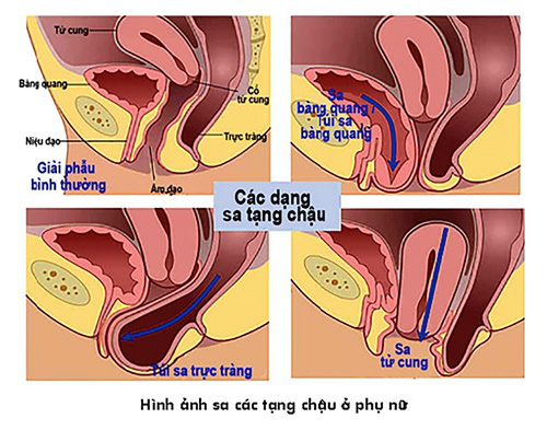 Sa tạng chậu - Căn bệnh thầm kín khiến nhiều phụ nữ mặc cảm - 1 Sa tạng chậu - Căn bệnh thầm kín khiến nhiều phụ nữ mặc cảm - 1