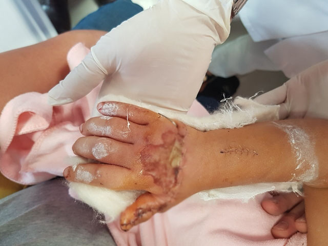 6 giờ đồng hồ căng thẳng, bằng phẫu thuật vi phẫu bác sĩ nối bàn tay phải đứt gần rời cho bé gái 3 tuổi 6 giờ đồng hồ căng thẳng, bằng phẫu thuật vi phẫu bác sĩ nối bàn tay phải đứt gần rời cho bé gái 3 tuổi