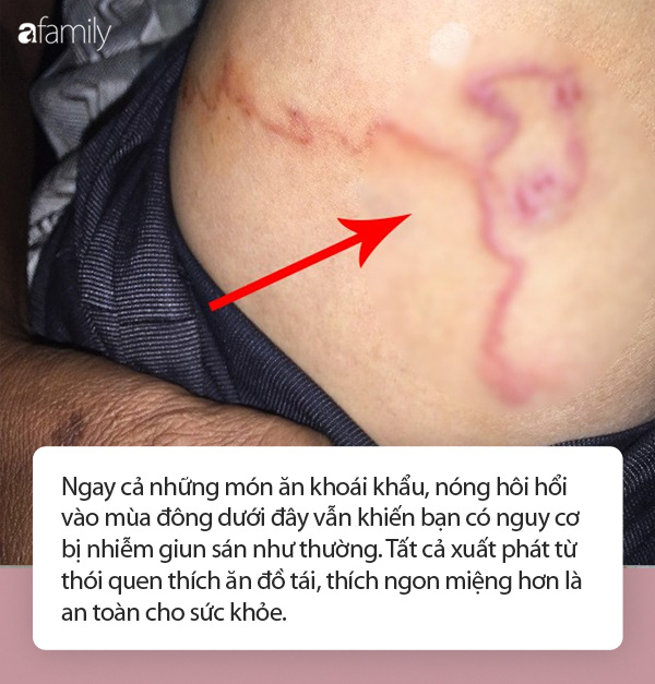 Những món khoái khẩu được nhiều người yêu thích khi gió lạnh nhưng đồng thời lại 'tiếp tay' cho giun sán chui vào làm tổ trong cơ thể Những món khoái khẩu được nhiều người yêu thích khi gió lạnh nhưng đồng thời lại 'tiếp tay' cho giun sán chui vào làm tổ trong cơ thể