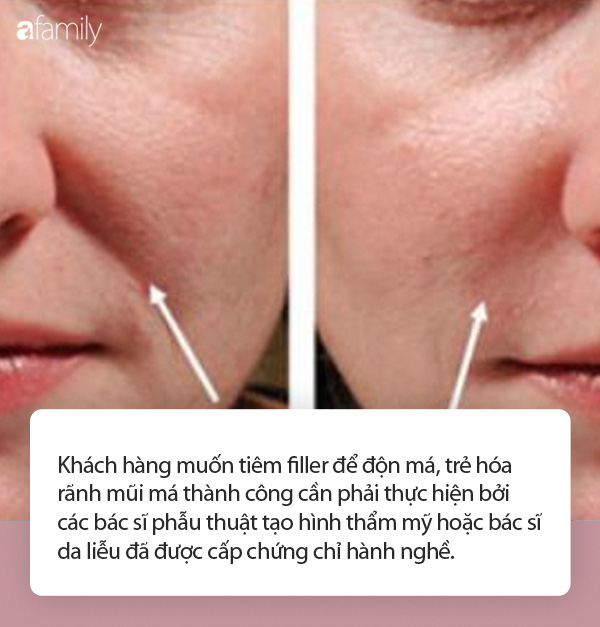 Nhiều người gặp biến chứng do tiêm filler trẻ hóa khuôn mặt, chuyên gia đưa ra khuyến cáo cực quan trọng mà ai cũng cần biết - 1 Nhiều người gặp biến chứng do tiêm filler trẻ hóa khuôn mặt, chuyên gia đưa ra khuyến cáo cực quan trọng mà ai cũng cần biết - 1