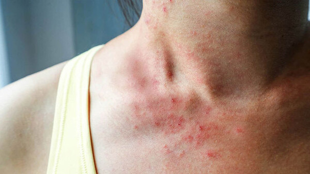 Cẩn thận với nguy cơ mắc bệnh tiểu đường trong dịp Tết nếu bạn gặp phải 2 triệu chứng ngứa từ cơ thể Cẩn thận với nguy cơ mắc bệnh tiểu đường trong dịp Tết nếu bạn gặp phải 2 triệu chứng ngứa từ cơ thể