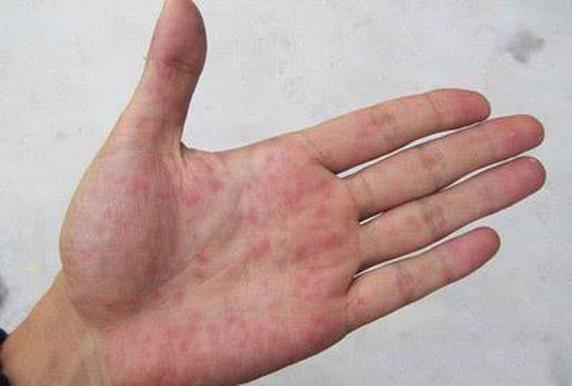 Nếu ngón tay xuất hiện những dấu hiệu này, cảnh giác ngay vì có thể bạn mắc ung thư phổi - 1 Nếu ngón tay xuất hiện những dấu hiệu này, cảnh giác ngay vì có thể bạn mắc ung thư phổi - 1