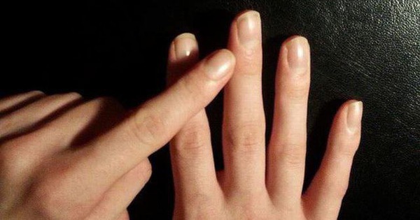 Nếu ngón tay xuất hiện những dấu hiệu này, cảnh giác ngay vì có thể bạn mắc ung thư phổi - 3 Nếu ngón tay xuất hiện những dấu hiệu này, cảnh giác ngay vì có thể bạn mắc ung thư phổi - 3