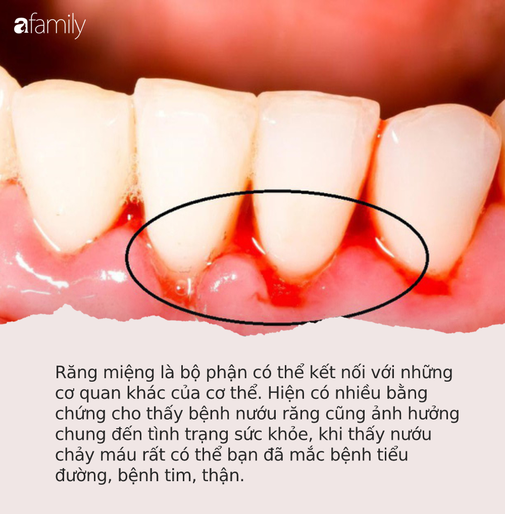 Bỗng dưng thấy răng miệng xuất hiện thứ này, đừng bỏ qua bởi có thể tim, gan, thận của bạn có thể đang gặp nguy hiểm! - 1 Bỗng dưng thấy răng miệng xuất hiện thứ này, đừng bỏ qua bởi có thể tim, gan, thận của bạn có thể đang gặp nguy hiểm! - 1