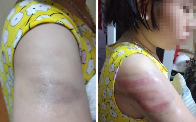 Nam Định: Yêu cầu cô giáo kiểm điểm sau sự việc bé gái bị đánh bầm tím cánh tay vì viết bài chậm Nam Định: Yêu cầu cô giáo kiểm điểm sau sự việc bé gái bị đánh bầm tím cánh tay vì viết bài chậm
