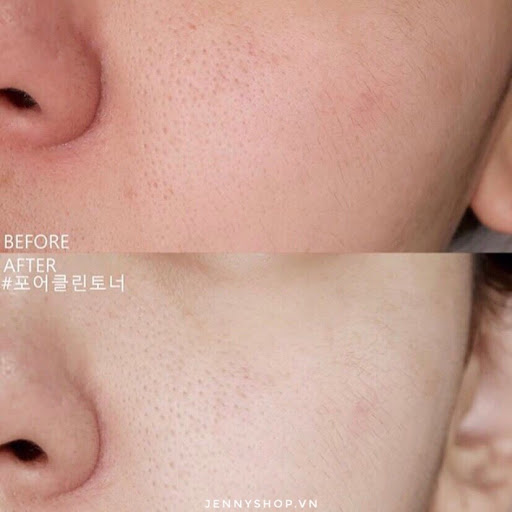Lỗ chân lông to ngoác hay mụn đầu đen khó trị đều bị 'thu phục' nhờ 4 dòng mask đất sét chuyên dụng cho mùa Hè - 8 Lỗ chân lông to ngoác hay mụn đầu đen khó trị đều bị 'thu phục' nhờ 4 dòng mask đất sét chuyên dụng cho mùa Hè - 8