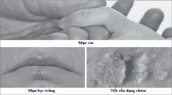 Tình dục bằng miệng, coi chừng lây bệnh Tình dục bằng miệng, coi chừng lây bệnh