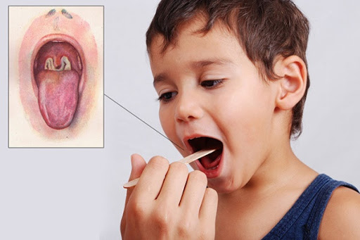 Bệnh bạch hầu 'tái xuất' nguy hiểm: Bác sĩ lưu ý những điều quan trọng - 2 Bệnh bạch hầu 'tái xuất' nguy hiểm: Bác sĩ lưu ý những điều quan trọng - 2
