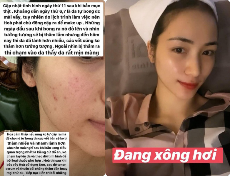 Hòa Minzy khoe da đẹp không tì vết sau chuỗi ngày mụn nhọt, vết thâm hoành hành: Bí kíp trị sạch mụn của cô nằm ở 2 loại nước uống siêu rẻ bán đầy ngoài chợ - 10 Hòa Minzy khoe da đẹp không tì vết sau chuỗi ngày mụn nhọt, vết thâm hoành hành: Bí kíp trị sạch mụn của cô nằm ở 2 loại nước uống siêu rẻ bán đầy ngoài chợ - 10