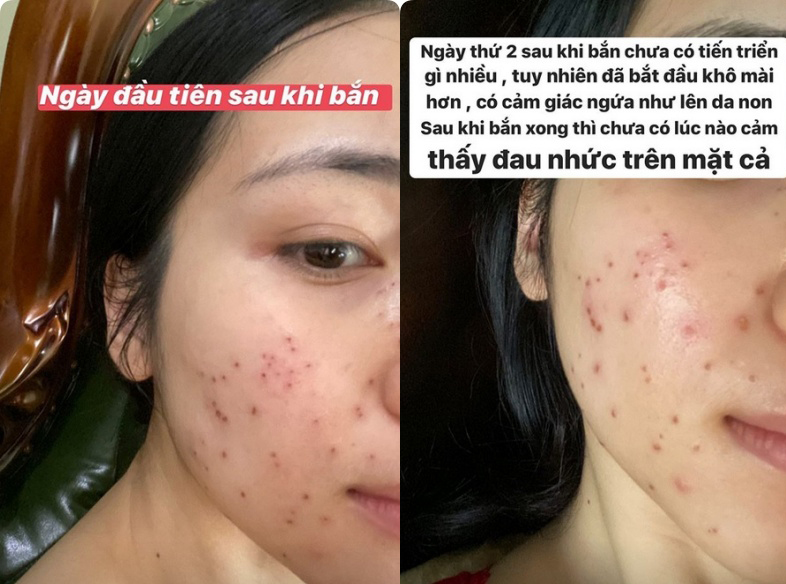 Hòa Minzy khoe da đẹp không tì vết sau chuỗi ngày mụn nhọt, vết thâm hoành hành: Bí kíp trị sạch mụn của cô nằm ở 2 loại nước uống siêu rẻ bán đầy ngoài chợ - 8 Hòa Minzy khoe da đẹp không tì vết sau chuỗi ngày mụn nhọt, vết thâm hoành hành: Bí kíp trị sạch mụn của cô nằm ở 2 loại nước uống siêu rẻ bán đầy ngoài chợ - 8