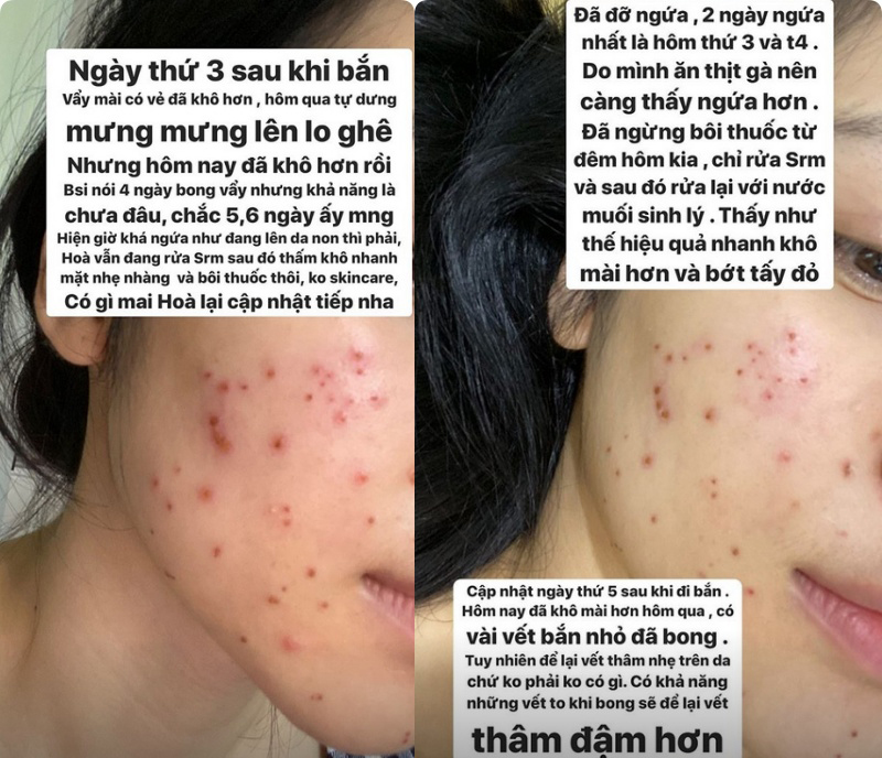 Hòa Minzy khoe da đẹp không tì vết sau chuỗi ngày mụn nhọt, vết thâm hoành hành: Bí kíp trị sạch mụn của cô nằm ở 2 loại nước uống siêu rẻ bán đầy ngoài chợ - 9 Hòa Minzy khoe da đẹp không tì vết sau chuỗi ngày mụn nhọt, vết thâm hoành hành: Bí kíp trị sạch mụn của cô nằm ở 2 loại nước uống siêu rẻ bán đầy ngoài chợ - 9