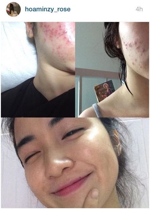 Hòa Minzy khoe da đẹp không tì vết sau chuỗi ngày mụn nhọt, vết thâm hoành hành: Bí kíp trị sạch mụn của cô nằm ở 2 loại nước uống siêu rẻ bán đầy ngoài chợ - 4 Hòa Minzy khoe da đẹp không tì vết sau chuỗi ngày mụn nhọt, vết thâm hoành hành: Bí kíp trị sạch mụn của cô nằm ở 2 loại nước uống siêu rẻ bán đầy ngoài chợ - 4
