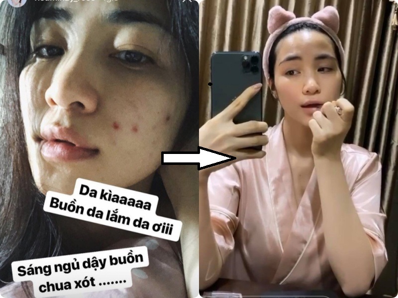 Hòa Minzy khoe da đẹp không tì vết sau chuỗi ngày mụn nhọt, vết thâm hoành hành: Bí kíp trị sạch mụn của cô nằm ở 2 loại nước uống siêu rẻ bán đầy ngoài chợ - 5 Hòa Minzy khoe da đẹp không tì vết sau chuỗi ngày mụn nhọt, vết thâm hoành hành: Bí kíp trị sạch mụn của cô nằm ở 2 loại nước uống siêu rẻ bán đầy ngoài chợ - 5