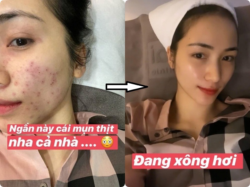 Hòa Minzy khoe da đẹp không tì vết sau chuỗi ngày mụn nhọt, vết thâm hoành hành: Bí kíp trị sạch mụn của cô nằm ở 2 loại nước uống siêu rẻ bán đầy ngoài chợ - 7 Hòa Minzy khoe da đẹp không tì vết sau chuỗi ngày mụn nhọt, vết thâm hoành hành: Bí kíp trị sạch mụn của cô nằm ở 2 loại nước uống siêu rẻ bán đầy ngoài chợ - 7